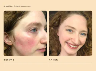 Side-by-side comparison of a woman's face showing skin before and after treatment, with the before image showing redness and the after image showing clear skin.