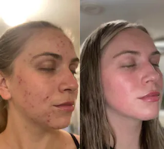 Side-by-side images depict a woman's face before and after using Tretinoin Cream for acne treatment. Left: acne visible on cheek. Right: clear skin with closed eyes, highlighting the cream's effectiveness.